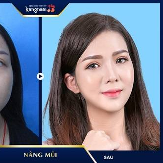 Nâng mũi thẩm mỹ